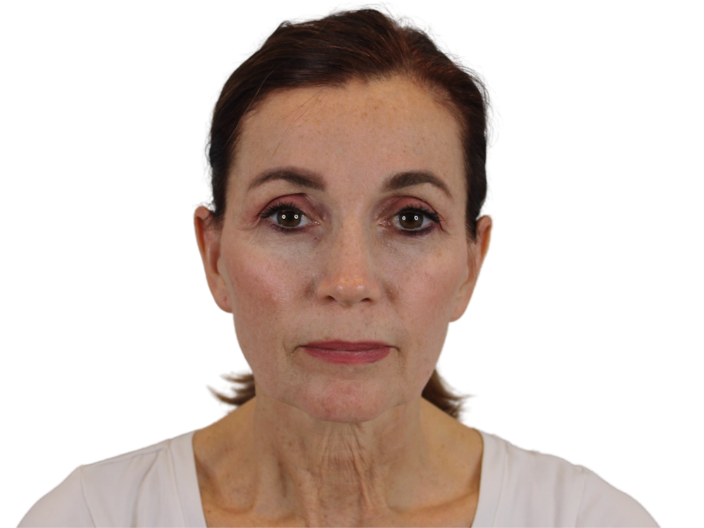 Deep Plane Facelift Before & After Gallery - Patient 59893925 - Image 1