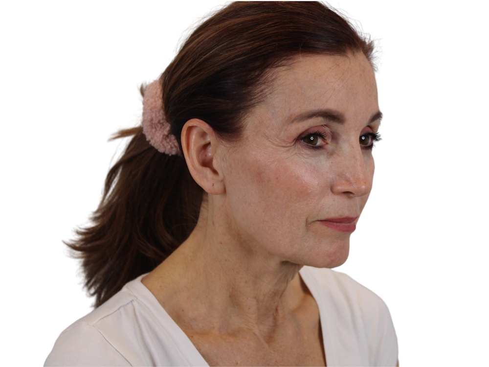 Deep Plane Facelift Before & After Gallery - Patient 59893925 - Image 7
