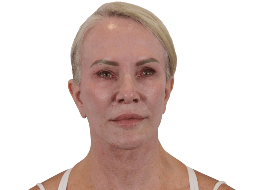 Deep Plane Facelift Before & After Gallery - Patient 74223305 - Image 2