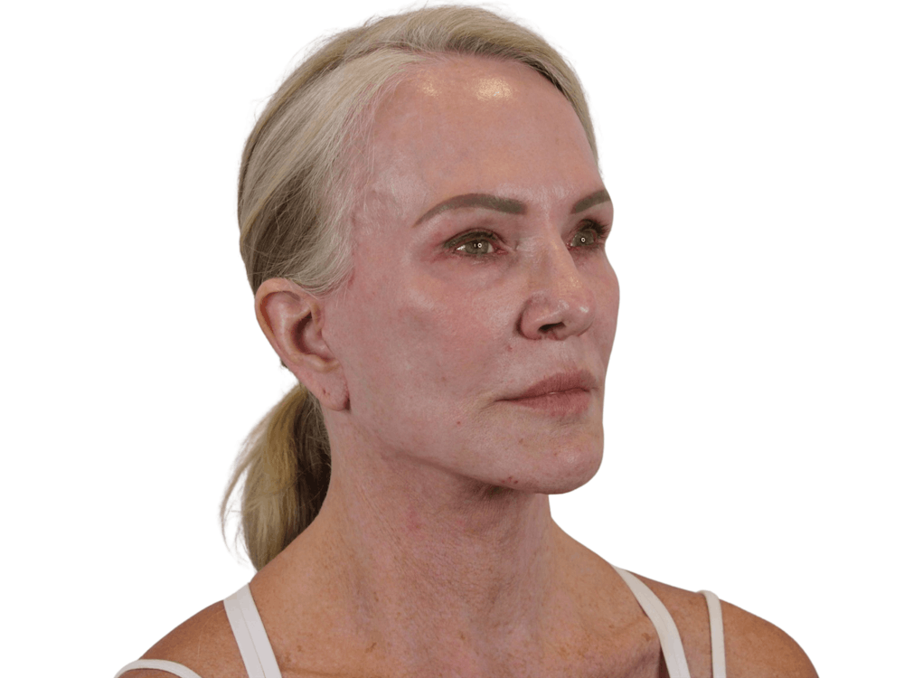 Deep Plane Facelift Before & After Gallery - Patient 74223305 - Image 4