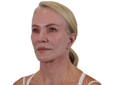 Deep Plane Facelift Before & After Gallery - Patient 74223305 - Image 6