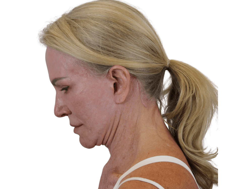 Deep Plane Facelift Before & After Gallery - Patient 74223305 - Image 8