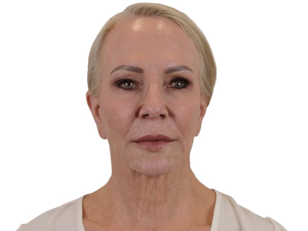 before and after neck lift in Phoenix