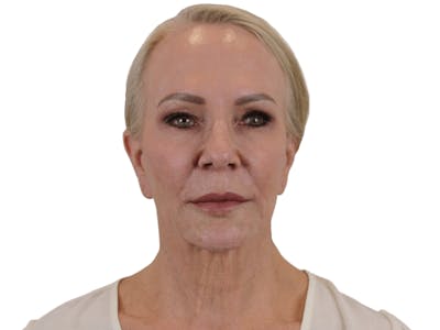 Facelift Before & After Gallery - Patient 74223305 - Image 1