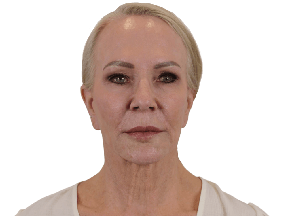Deep Plane Facelift Before & After Gallery - Patient 74223305 - Image 1