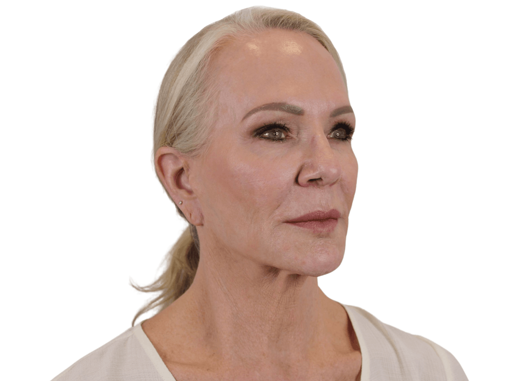 Deep Plane Facelift Before & After Gallery - Patient 74223305 - Image 3
