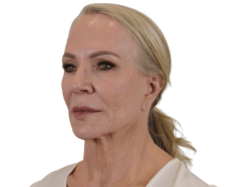 Deep Plane Facelift Before & After Gallery - Patient 74223305 - Image 5