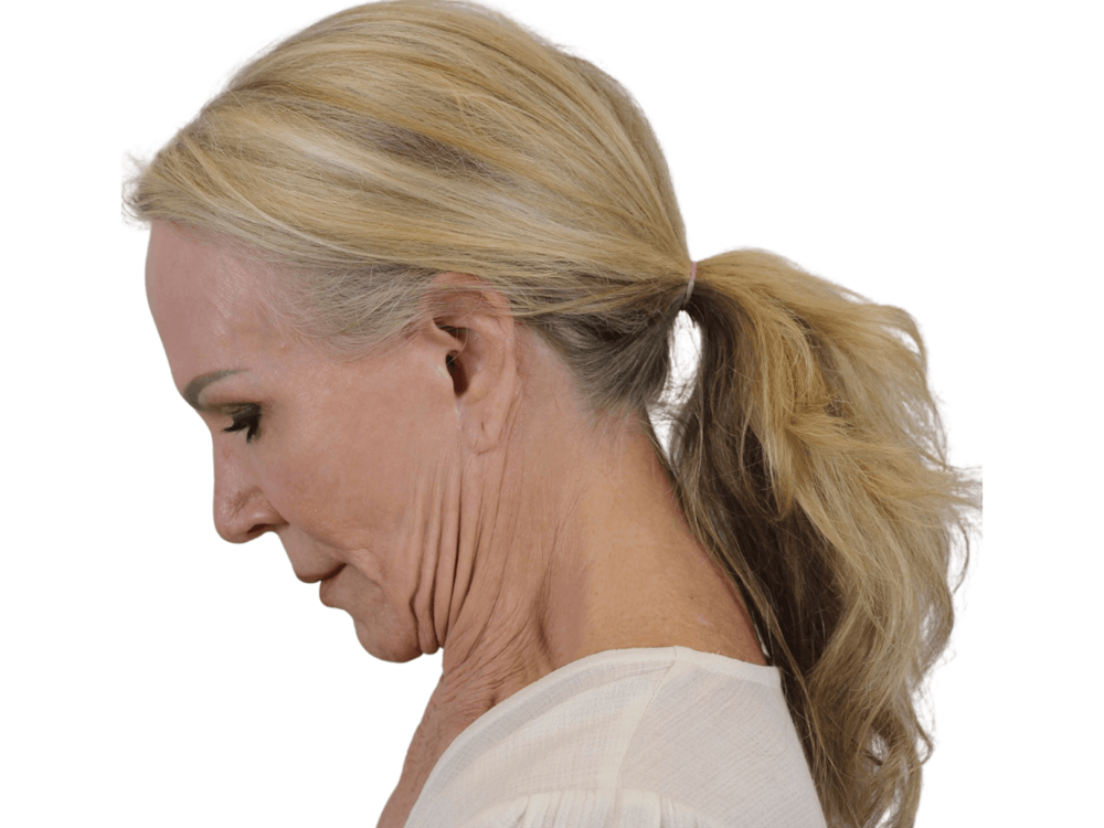 Deep Plane Facelift Before & After Gallery - Patient 74223305 - Image 7