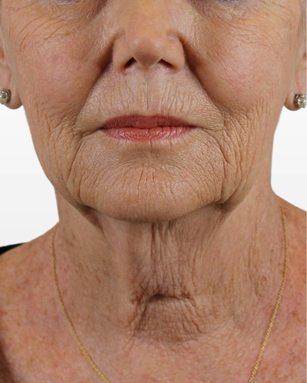 Lip Lift Before & After Gallery - Patient 74226511 - Image 1