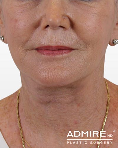 Deep Neck Lift Before & After Gallery - Patient 74226495 - Image 2