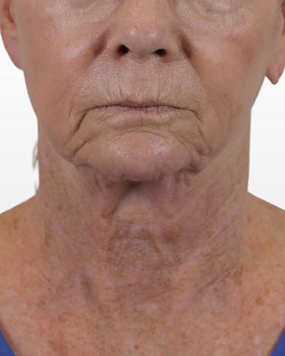 Deep Neck Lift Before & After Gallery - Patient 74226496 - Image 1