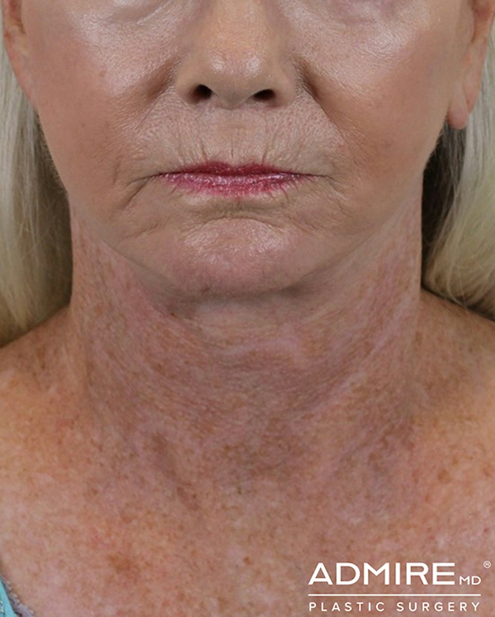 Deep Neck Lift Before & After Gallery - Patient 74226496 - Image 2