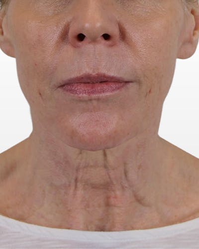 Neck Lift Before & After Gallery - Patient 74226497 - Image 1