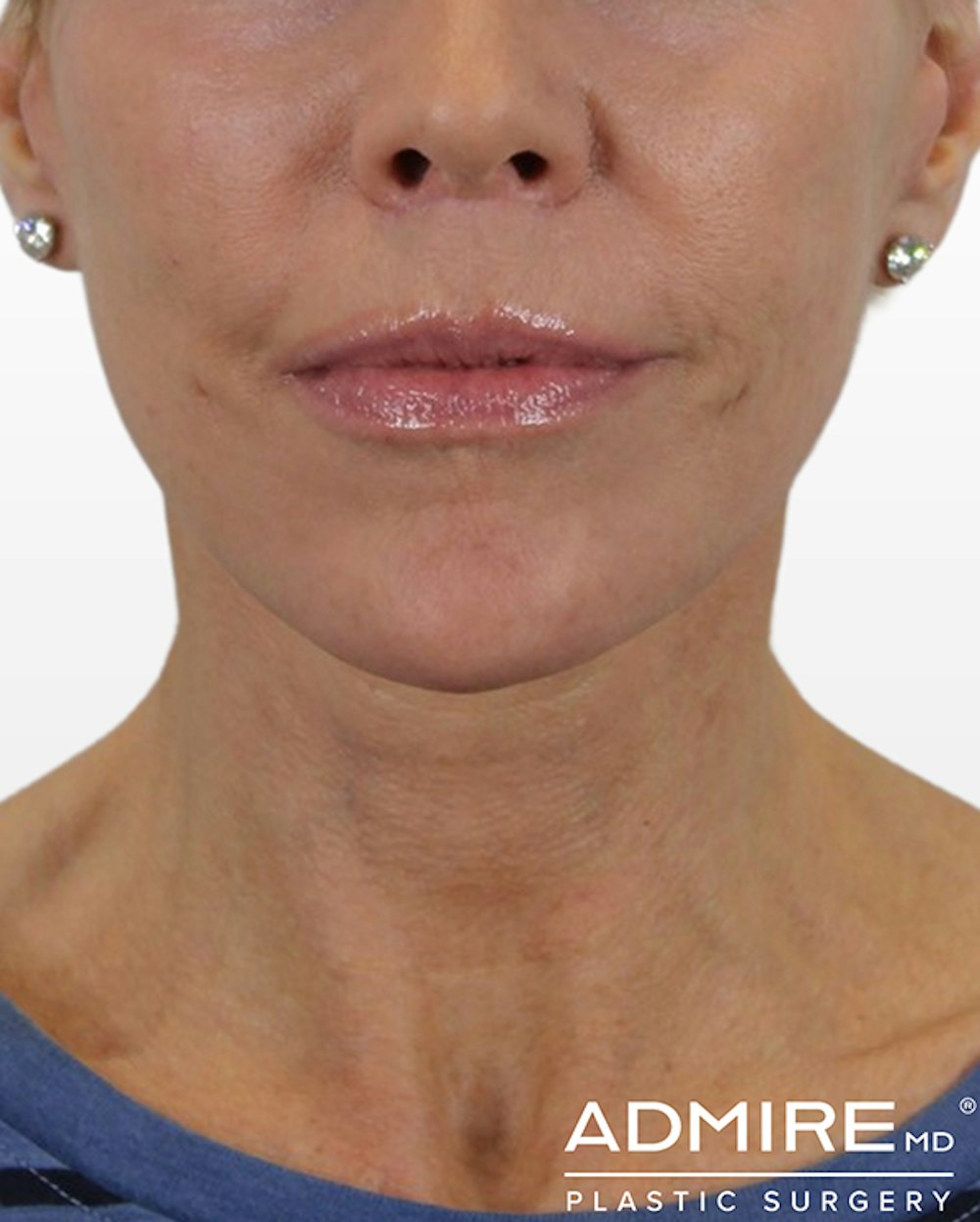 Neck Lift Before & After Gallery - Patient 74226497 - Image 2