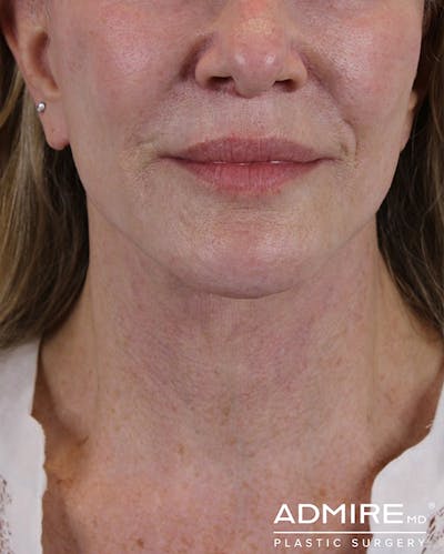 Deep Neck Lift Before & After Gallery - Patient 74226498 - Image 2