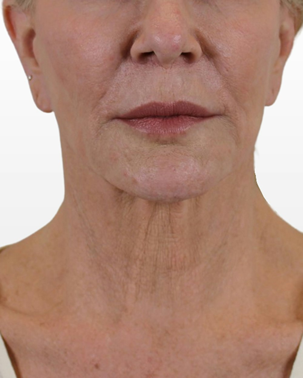 Deep Neck Lift Before & After Gallery - Patient 74226498 - Image 1