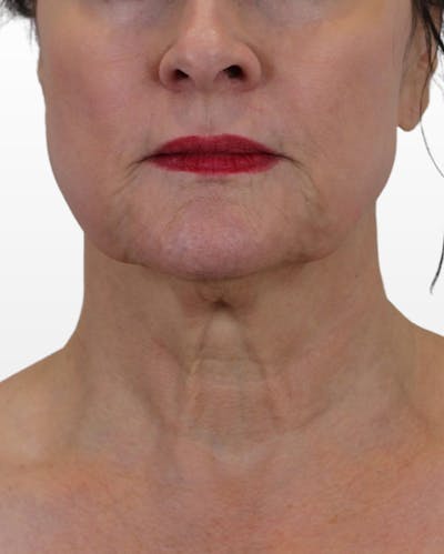 Lip Lift Before & After Gallery - Patient 74226515 - Image 1