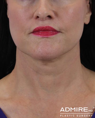 Deep Neck Lift Before & After Gallery - Patient 74226499 - Image 2