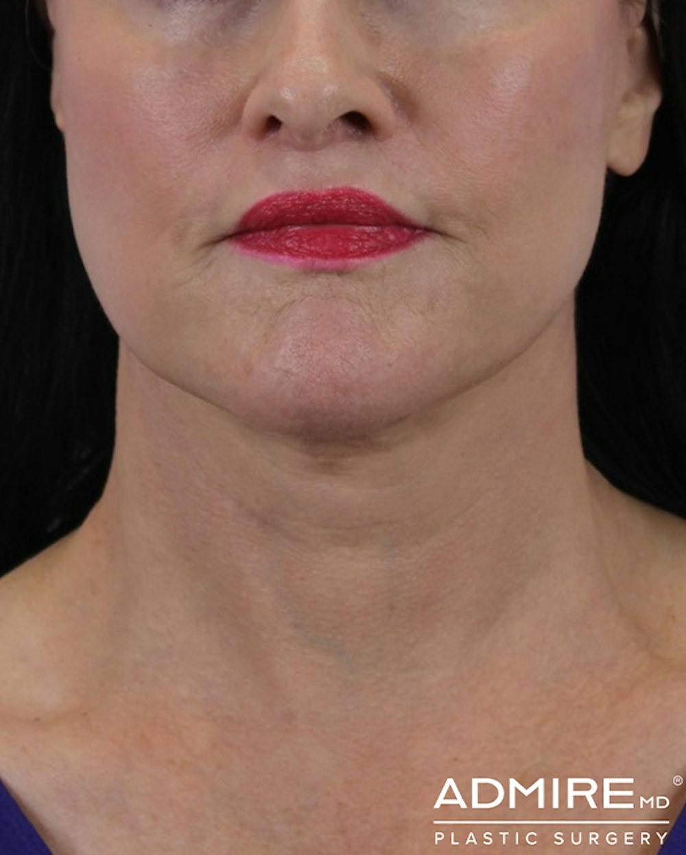 Lip Lift Before & After Gallery - Patient 74226515 - Image 2