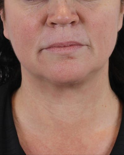 Lip Lift Before & After Gallery - Patient 74226516 - Image 1