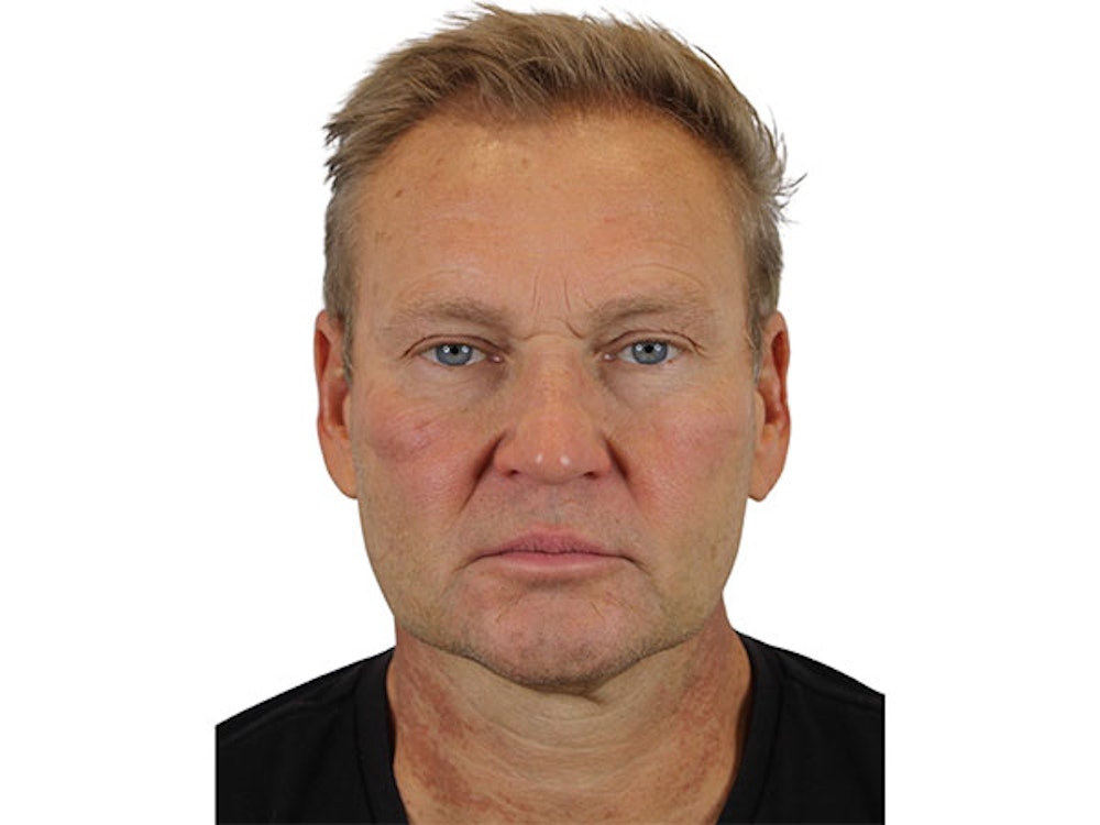 Facelift Before & After Gallery - Patient 91738675 - Image 1
