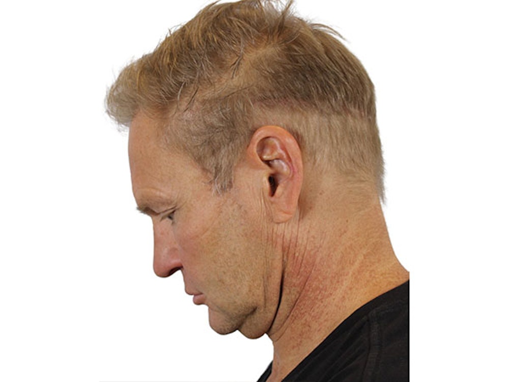 Facelift Before & After Gallery - Patient 91738675 - Image 7