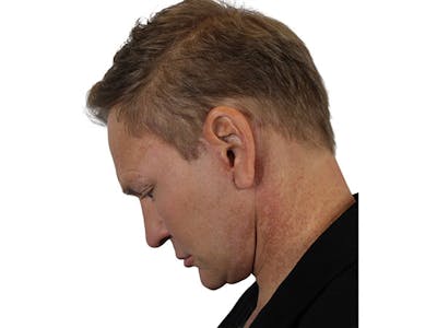 Neck Lift Before & After Gallery - Patient 91738708 - Image 8
