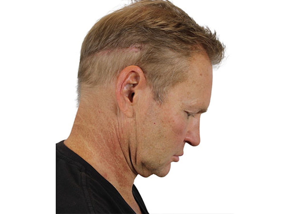 Neck Lift Before & After Gallery - Patient 91738708 - Image 9