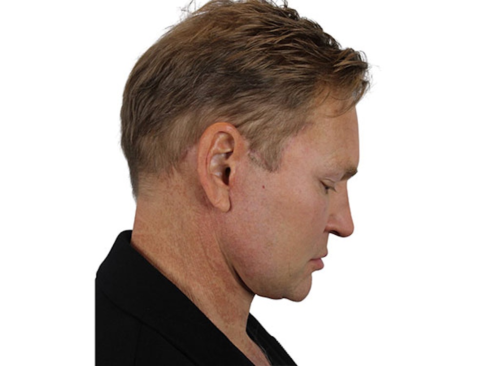 Neck Lift Before & After Gallery - Patient 91738708 - Image 10