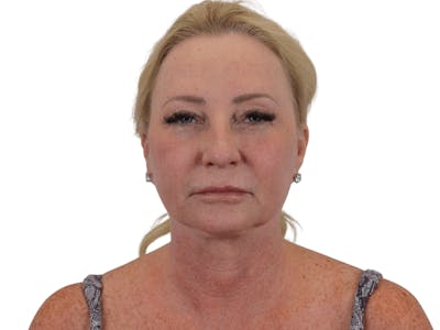 Facelift Before & After Gallery - Patient 101058976 - Image 1