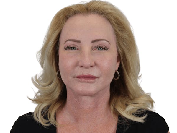 before and after neck lift in Scottsdale