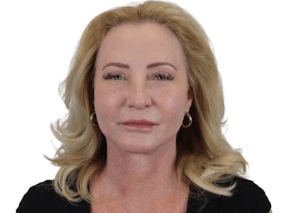 Deep Plane Facelift Before & After Gallery - Patient 101058976 - Image 2