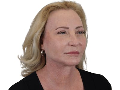 Deep Plane Facelift Before & After Gallery - Patient 101058976 - Image 4
