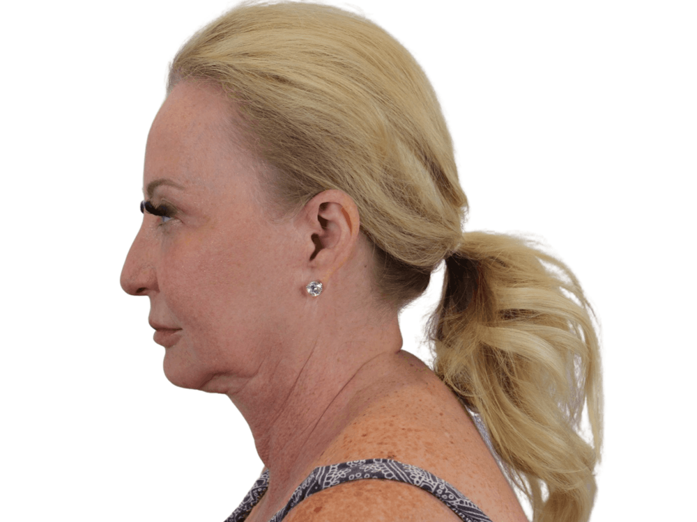 Deep Plane Facelift Before & After Gallery - Patient 101058976 - Image 5