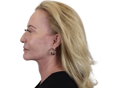 Deep Neck Lift Before & After Gallery - Patient 101059009 - Image 6
