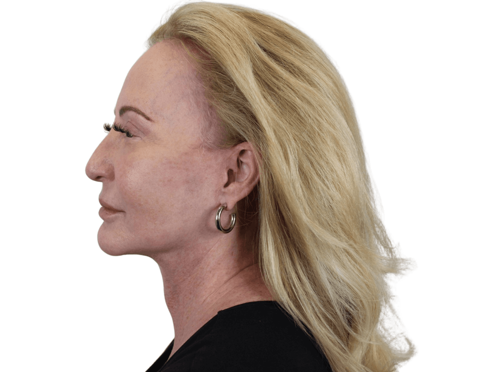 Deep Plane Facelift Before & After Gallery - Patient 101058976 - Image 6