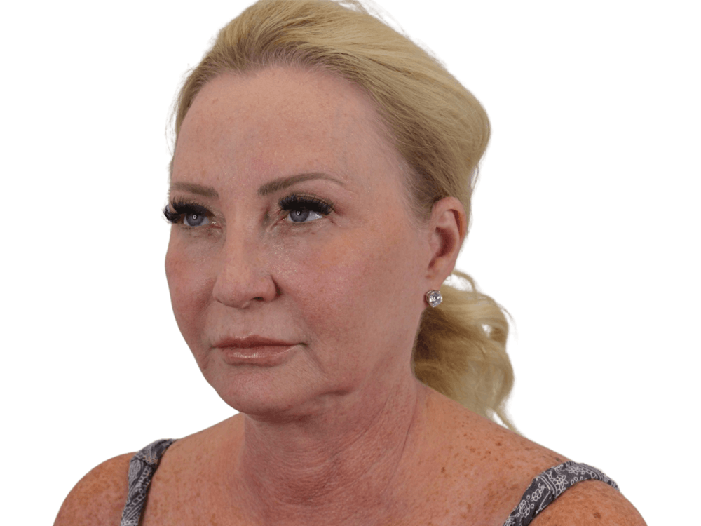 Deep Neck Lift Before & After Gallery - Patient 101059009 - Image 7