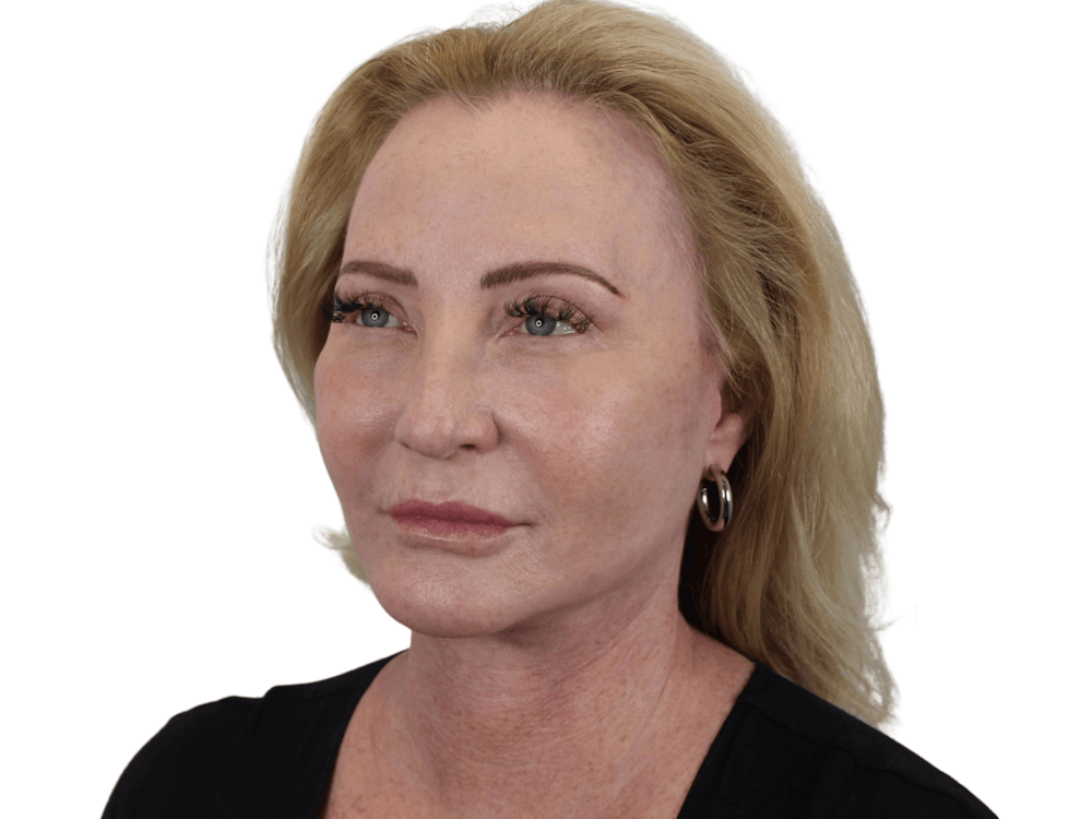Deep Plane Facelift Before & After Gallery - Patient 101058976 - Image 8