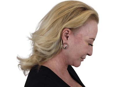 Deep Neck Lift Before & After Gallery - Patient 101059009 - Image 10