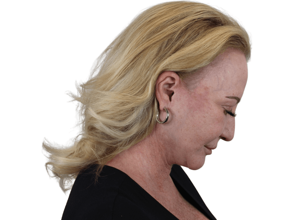 Deep Plane Facelift Before & After Gallery - Patient 101058976 - Image 10