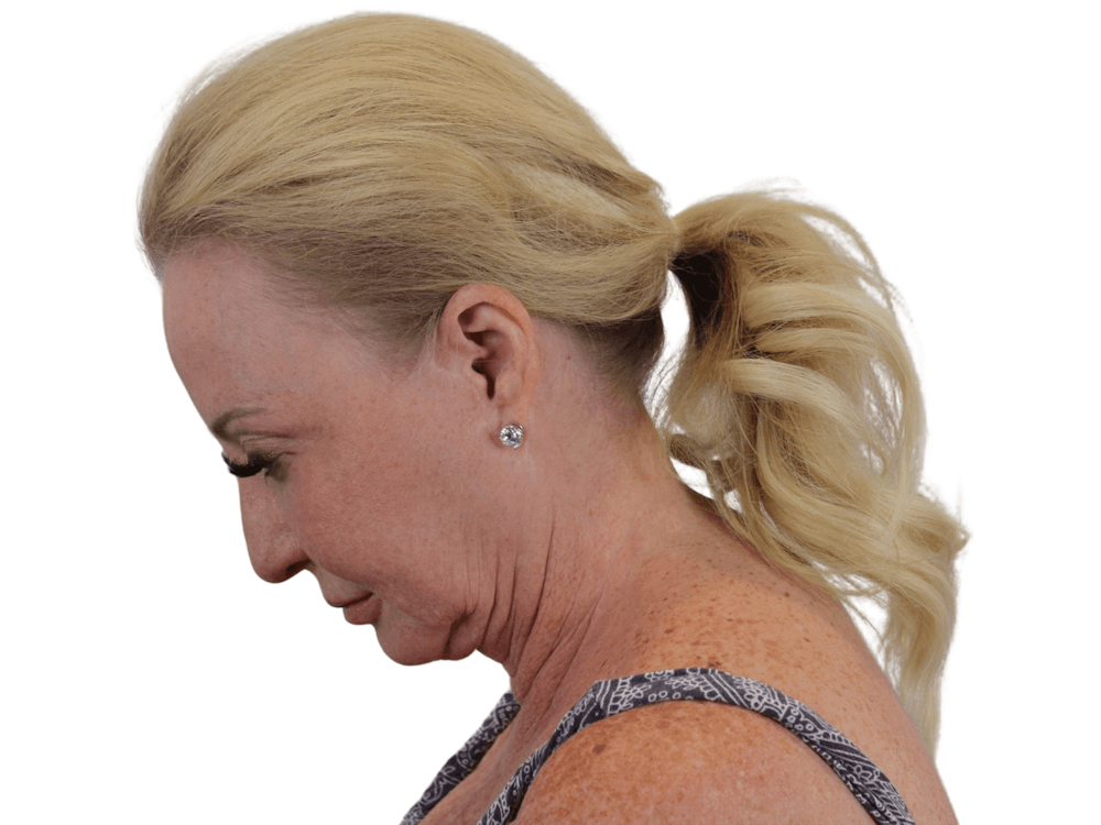 Deep Plane Facelift Before & After Gallery - Patient 101058976 - Image 11