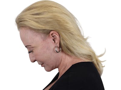 Deep Neck Lift Before & After Gallery - Patient 101059009 - Image 12