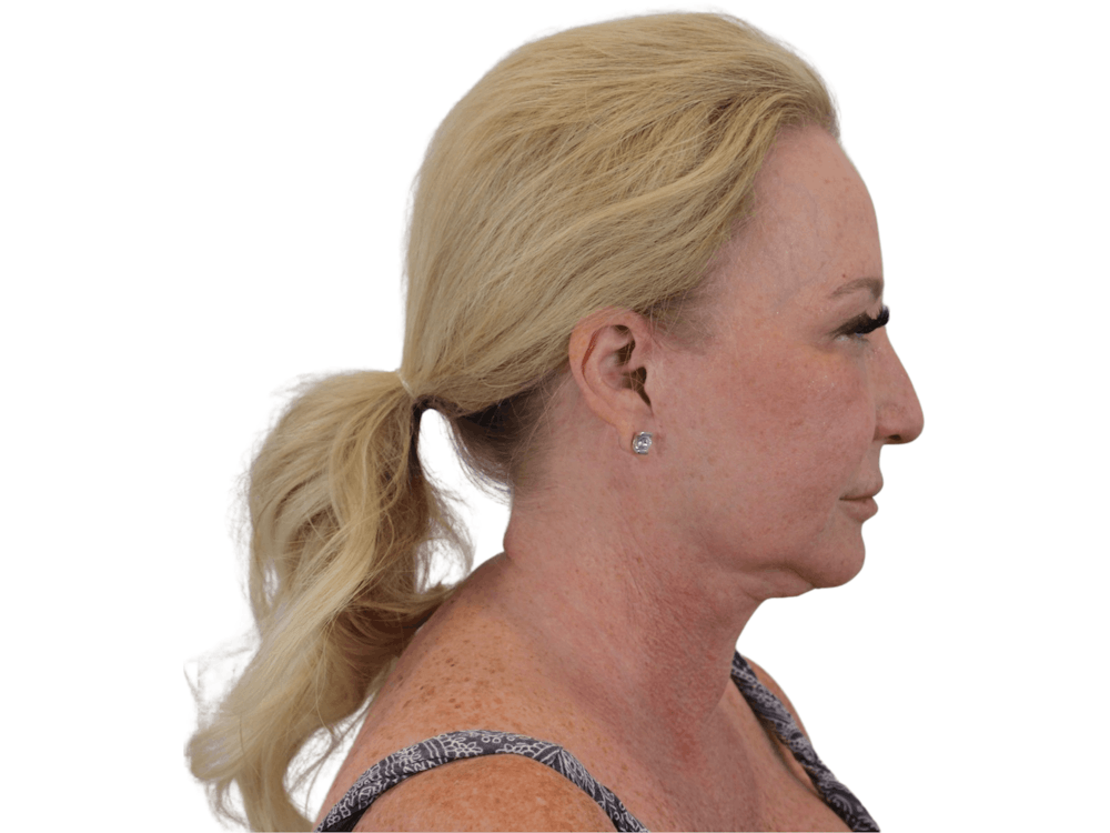 Deep Plane Facelift Before & After Gallery - Patient 101058976 - Image 13