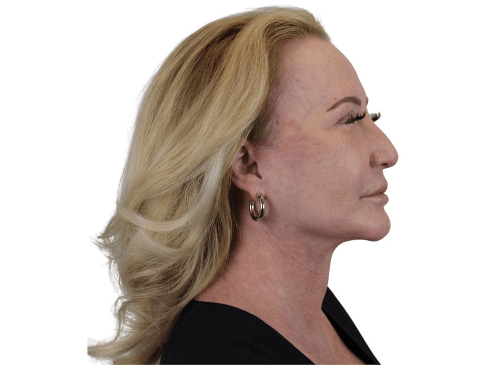 Deep Neck Lift Before & After Gallery - Patient 101059009 - Image 14