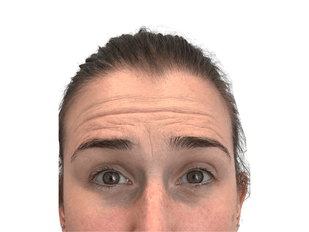 BOTOX  Before & After Gallery - Patient 53828874 - Image 3