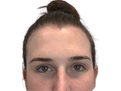 BOTOX  Before & After Gallery - Patient 53828874 - Image 4