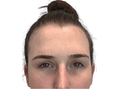 BOTOX  Before & After Gallery - Patient 53828874 - Image 6