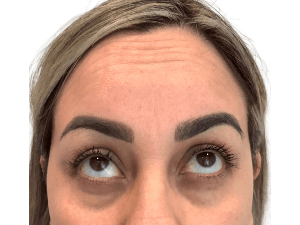 BOTOX  Before & After Gallery - Patient 53828873 - Image 3