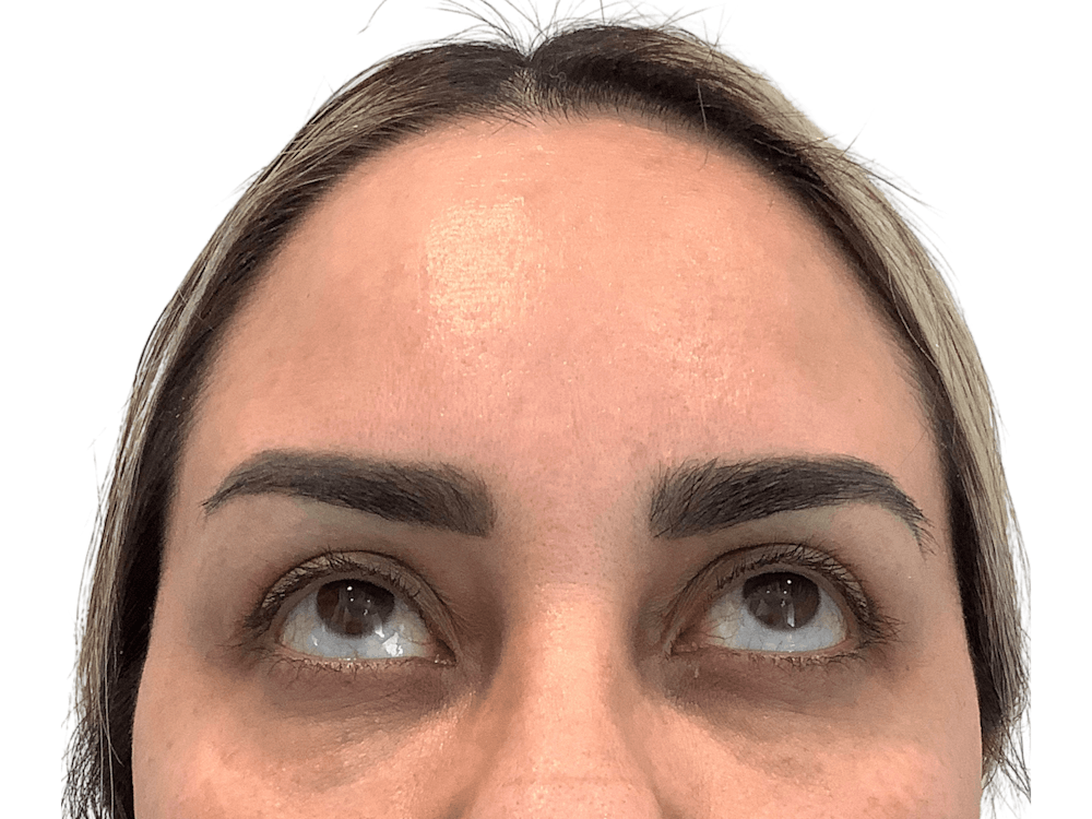 BOTOX  Before & After Gallery - Patient 53828873 - Image 4