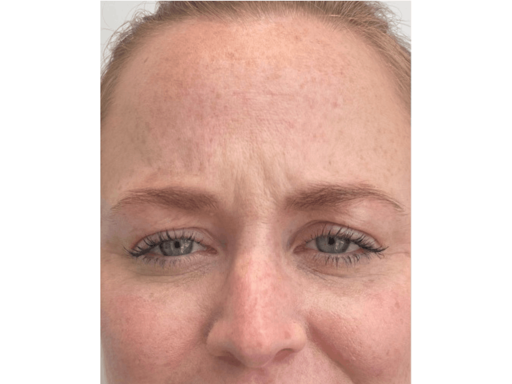 BOTOX  Before & After Gallery - Patient 103403184 - Image 1